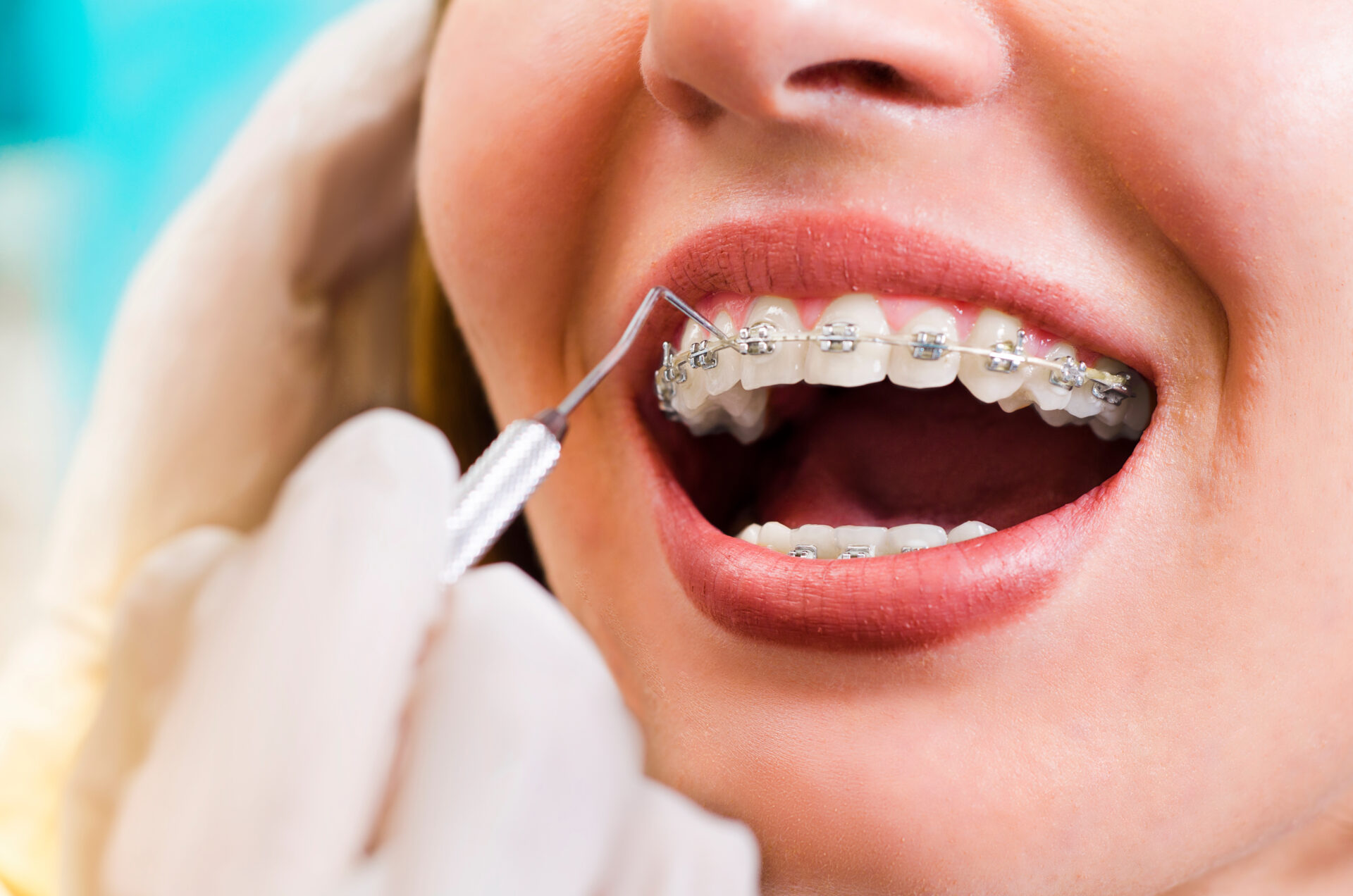 What Causes Crooked Teeth? Exploring the Factors with Broadbent Orthodontics
