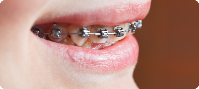 Self Lighting Braces | Orthodontic Treatments in North Ogden, UT